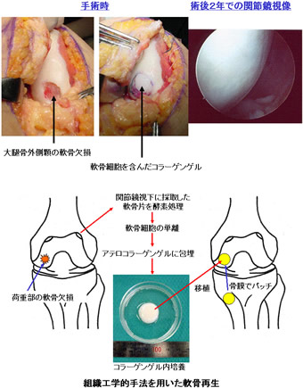 膝関節鏡下手術 - 健康/医学