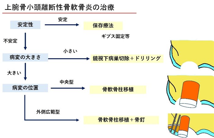 上腕骨小頭離断性骨軟骨炎の治療