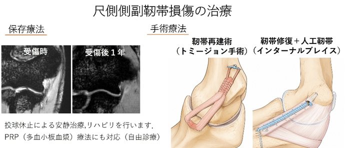 尺側側副靭帯損傷の治療