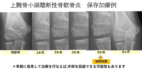 上腕骨小頭離断性骨軟骨炎　保存加療例